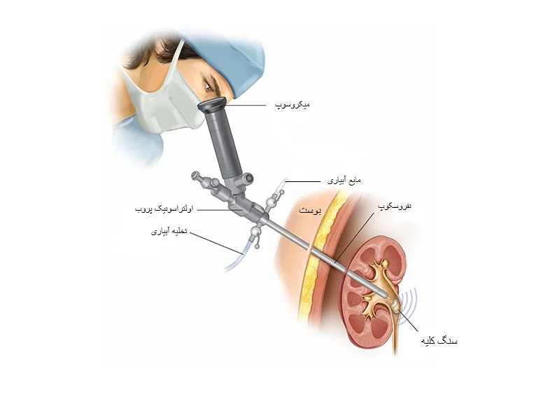 عمل pcnl سنگ کلیه