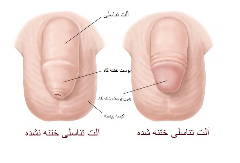 جوانسازی آلت تناسلی مردان