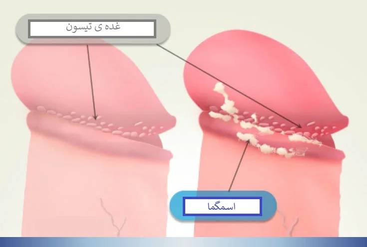 عکس توده سفت زیر پوست در ناحیه تناسلی مردان