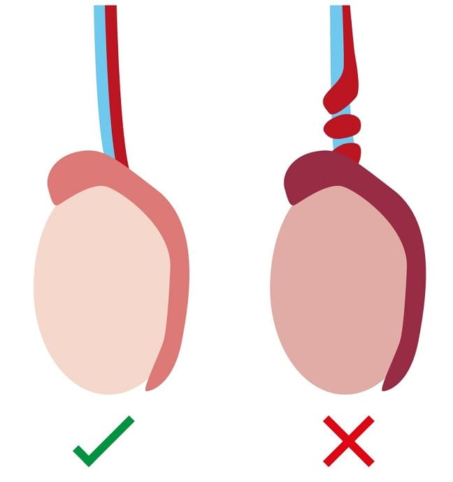 پیچ خوردگی بیضه