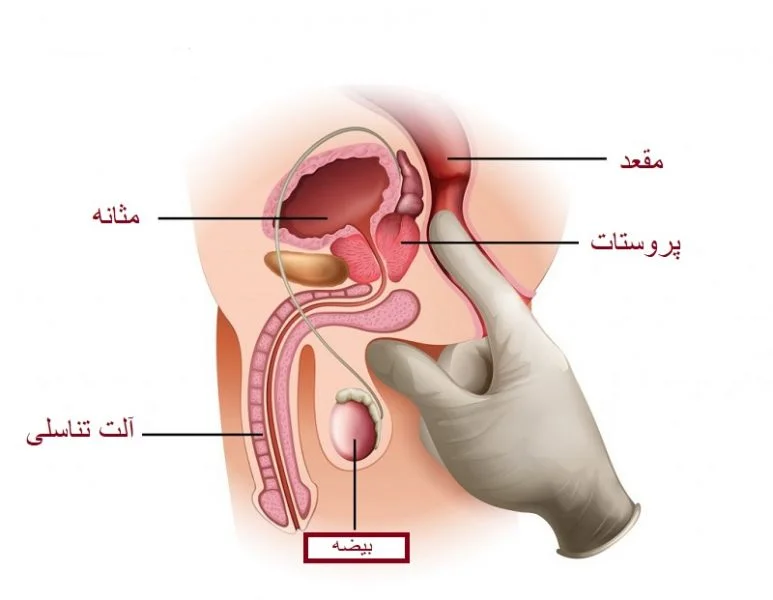 معاینه مقعد با انگشت