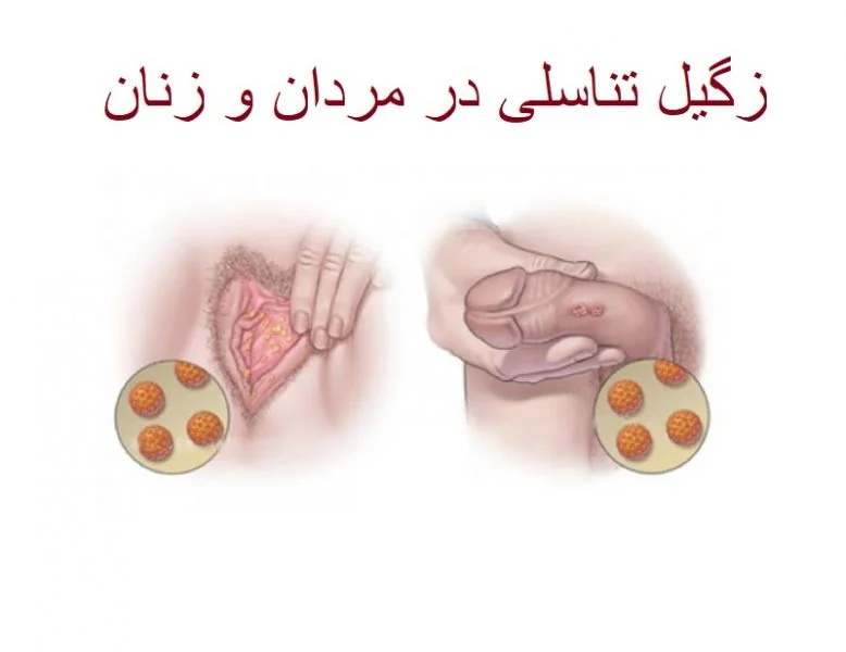 زگیل تناسلی