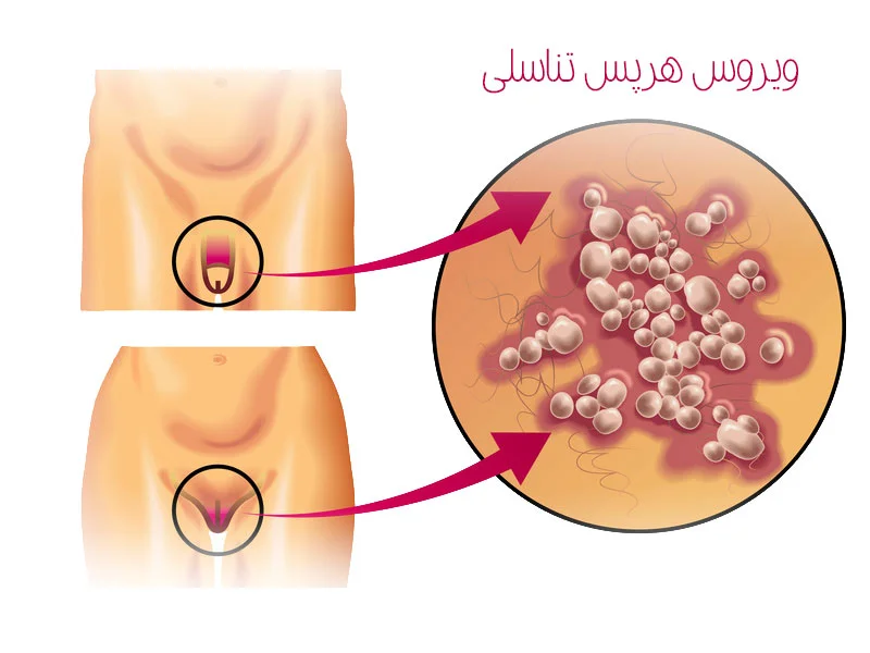 هرپس تناسلی