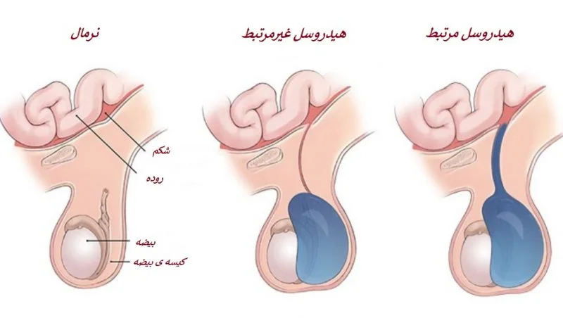 انواع هیدروسل