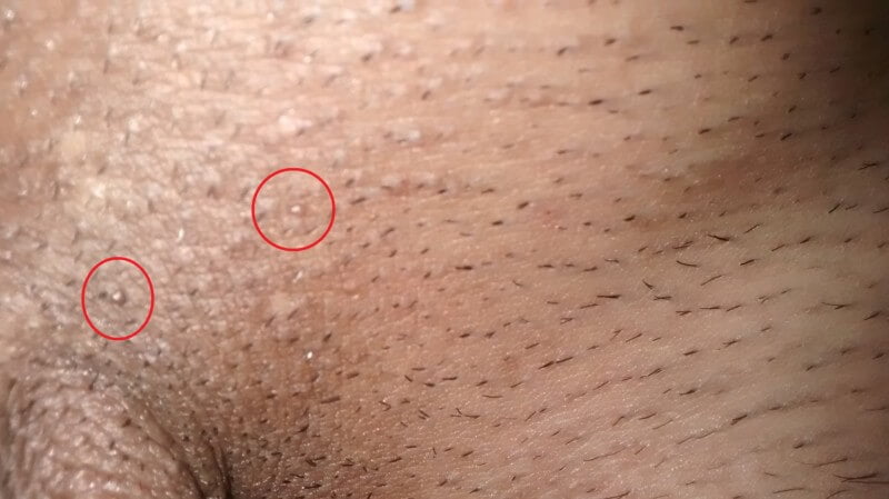 زگیل تناسلی خفیف