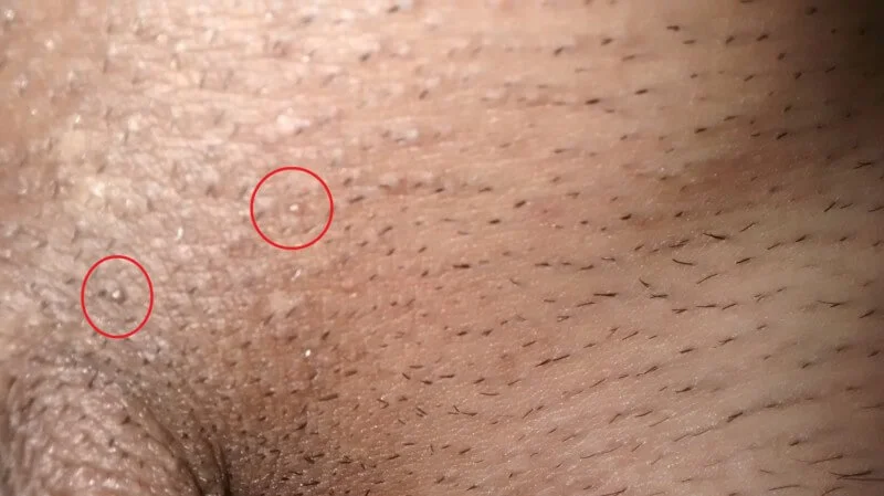 زگیل تناسلی خفیف