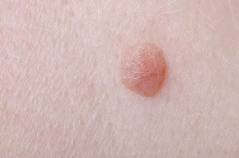 زگیل در ناحیه تناسلی