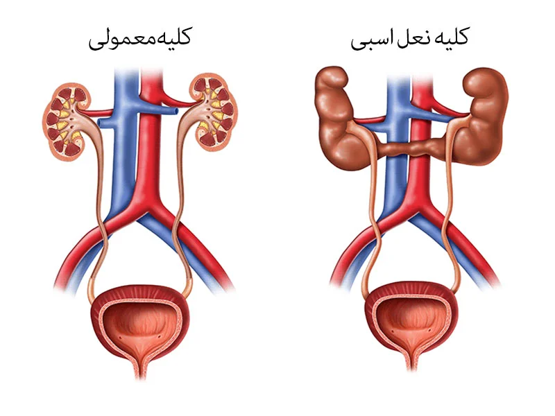 کلیه طبیعی و کلیه نعل اسبی