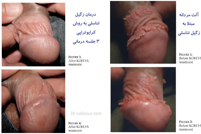 کرایوتراپی زگیل تناسلی مردانه