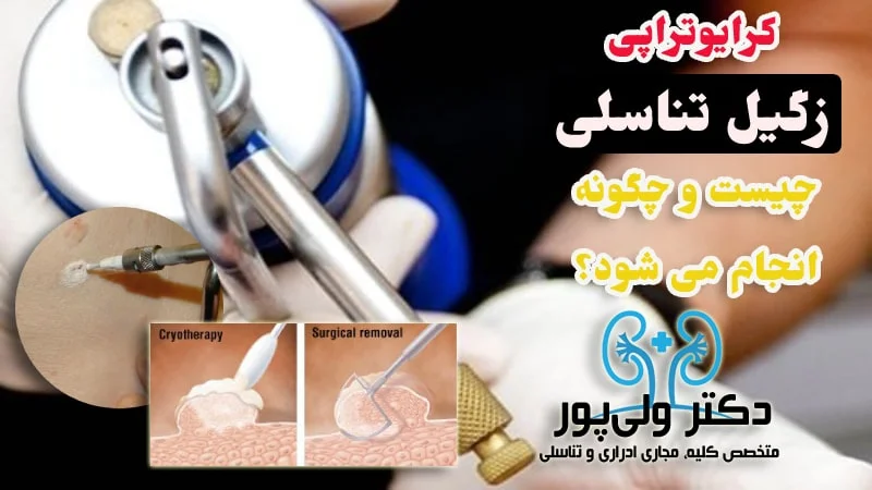 عکس کرایوتراپی زگیل تناسلی