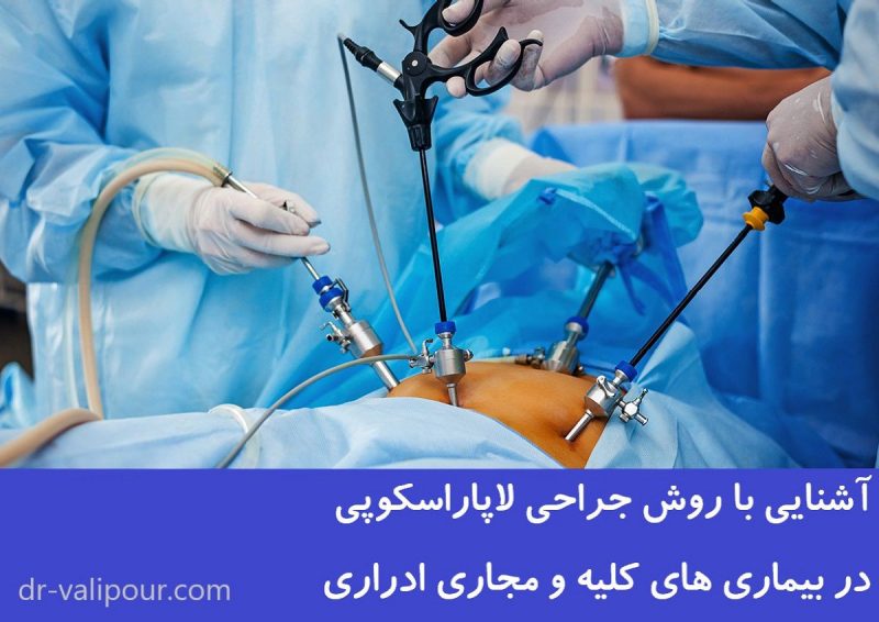 عمل لاپاراسکوپی سنگ کلیه