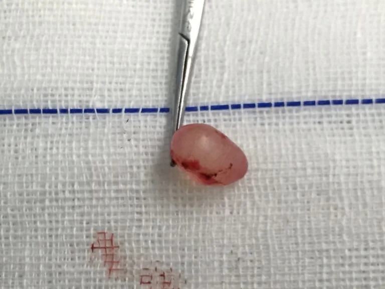 درمان با جراحی اسپرماتوسل