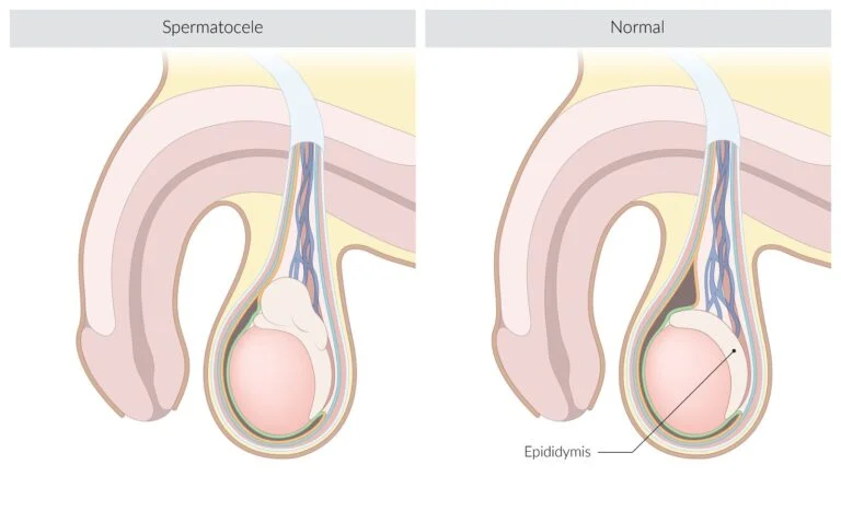 اسپرماتوسل (کیست بیضه)