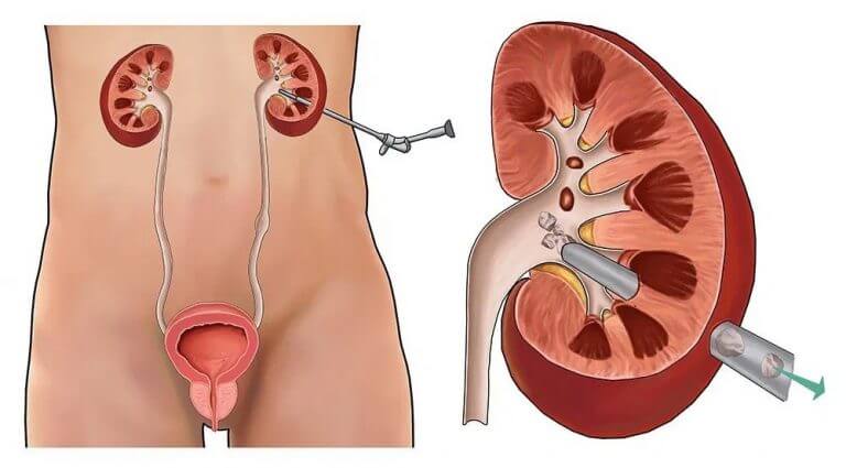 عمل pcnl کلیه