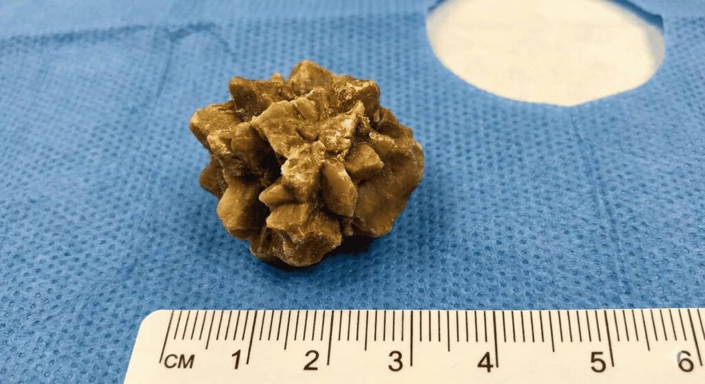 عکس سنگ کلیه ۲۵ میلیمتری