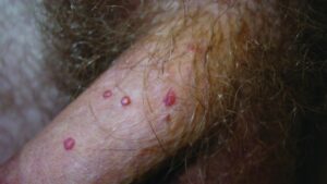 زگیل تناسلی خفیف در مردان