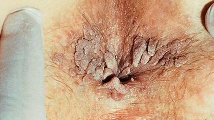 عکس زگیل تناسلی مقعدی مردان