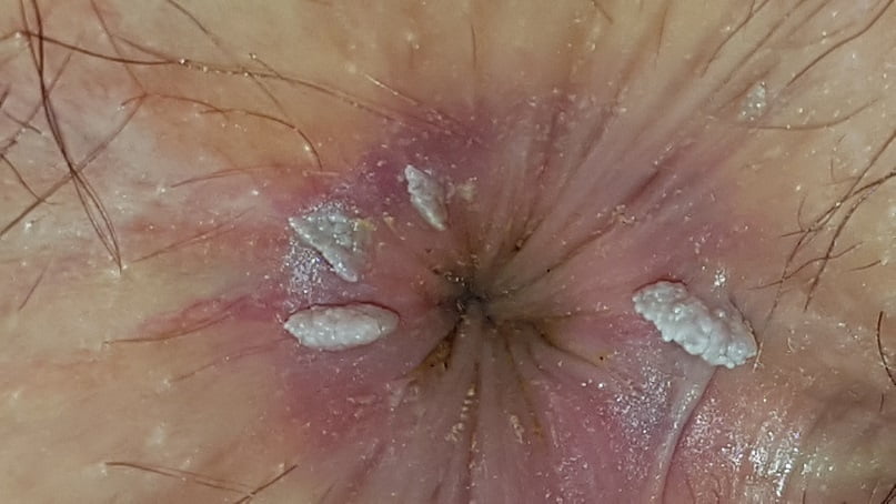 عکس زگیل تناسلی روی مقعد زنان