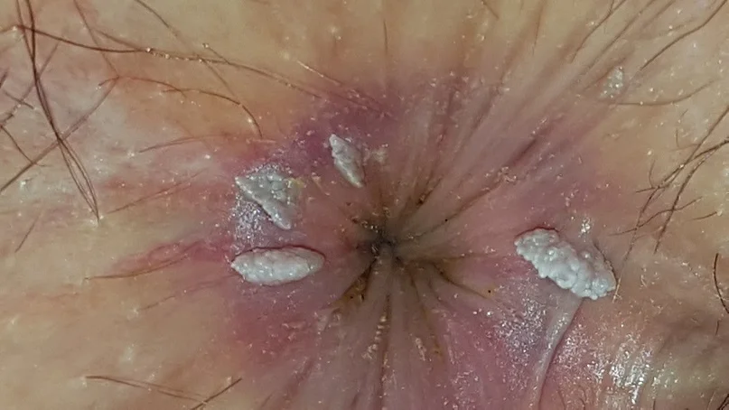 عکس زگیل تناسلی روی مقعد زنان