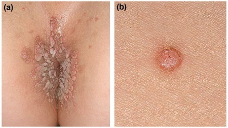 عکس زگیل تناسلی روی مقعد