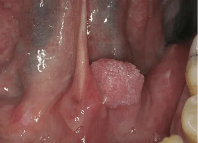 عکس زگیل تناسلی در دهان