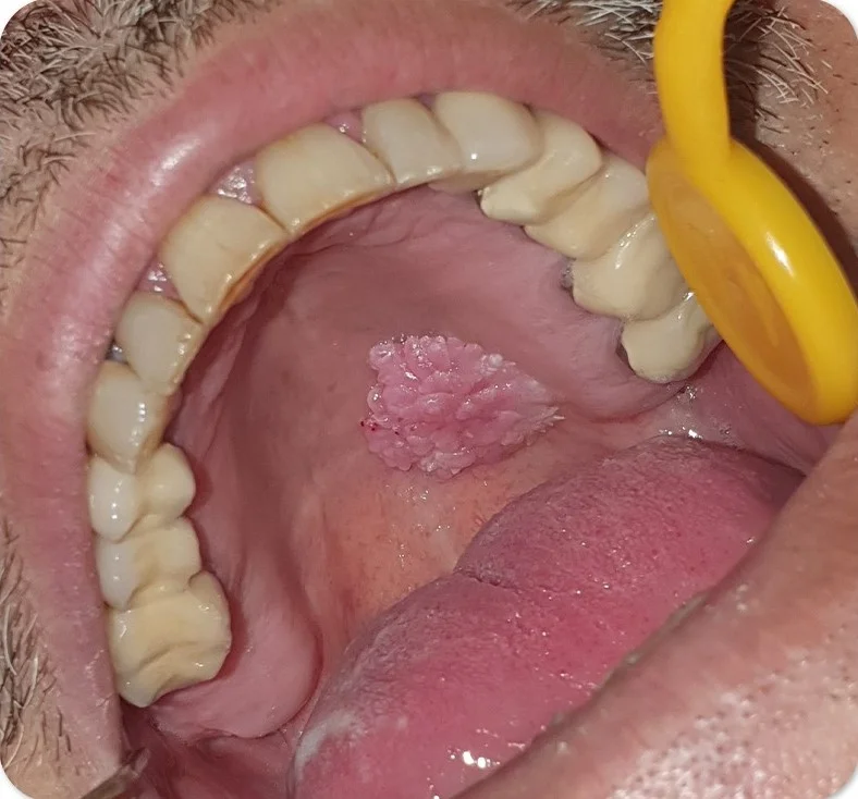 عکس زگیل تناسلی ایجاد شده در دهان