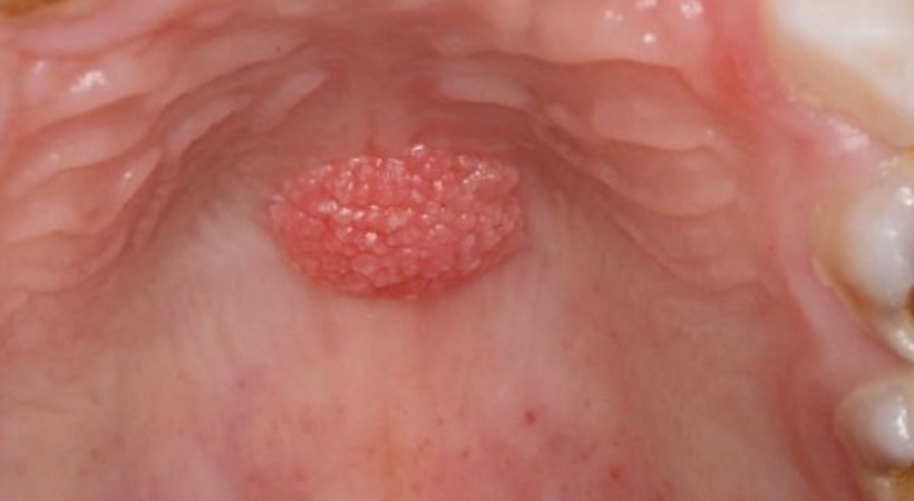 عکس زگیل ایجاد شده در دهان