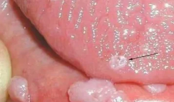 عکس زگیل تناسلی ایجاد شده روی زبان