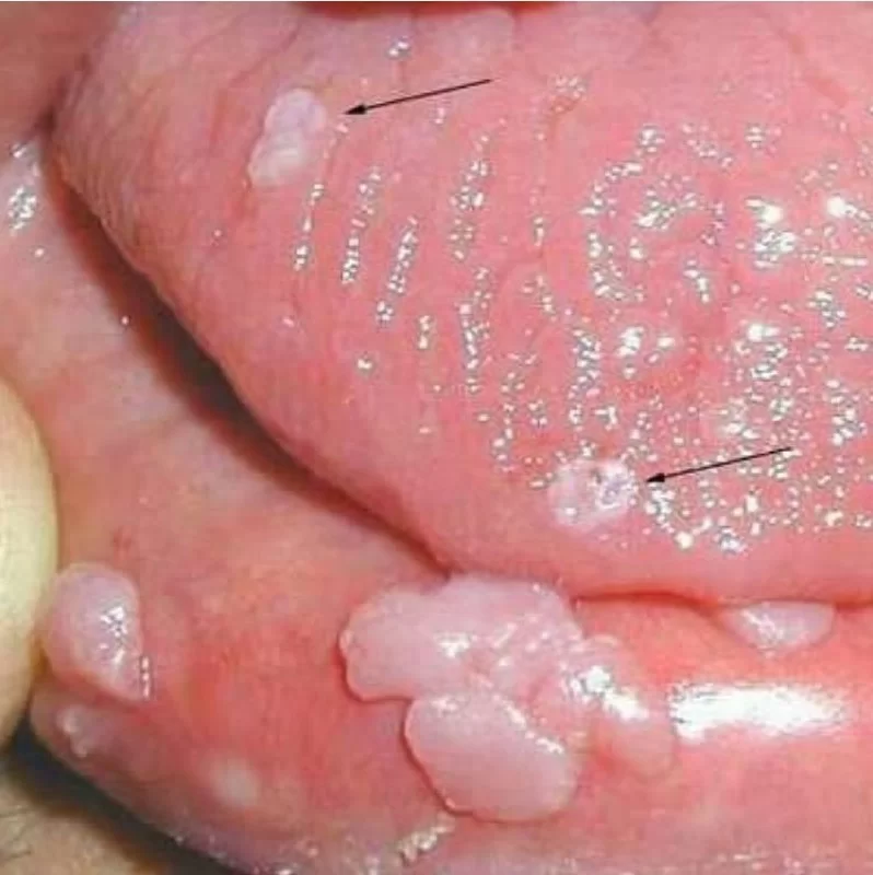 عکس زگیل تناسلی ایجاد شده روی زبان