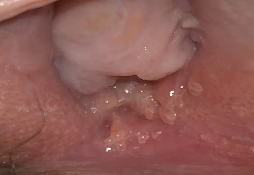 عکس زگیل تناسلی در دهانه رحم بانوان