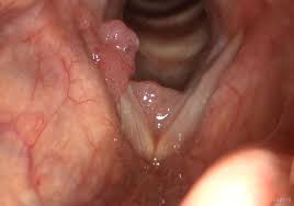 عکس زگیل تناسلی داخل رحم