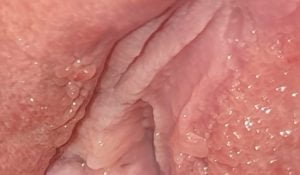 عکس زگیل تناسلی داخل رحم زنان