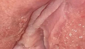 عکس زگیل تناسلی داخل رحم زنان