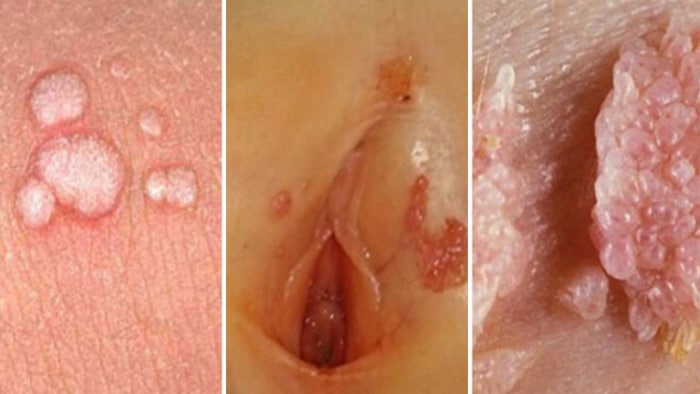 عکس زگیل تناسلی روی رحم زنان