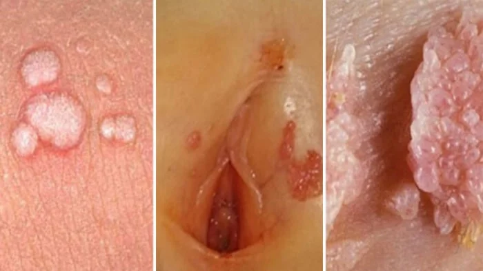 عکس زگیل تناسلی روی رحم زنان