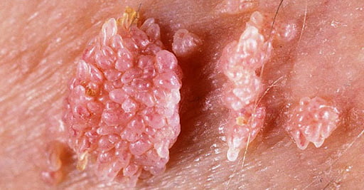 عکس زگیل تناسلی واژینال