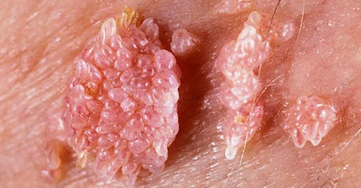 عکس زگیل تناسلی واژینال