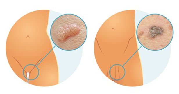 زگیل تناسلی چه مدت باقی می ماند؟