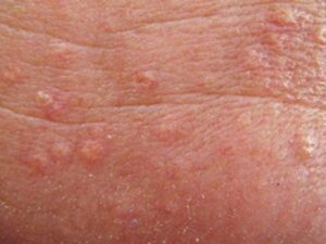 شکل زگیل تناسلی خفیف مردان