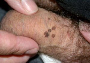 شکل زگیل تناسلی خفیف 