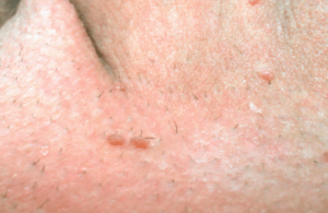 عکس زگیل تناسلی خفیف زنان