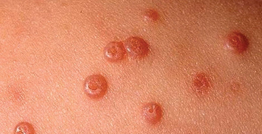 چگونگی ایجاد زگیل تناسلی خفیف در زنان