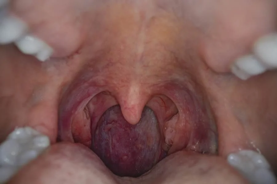 زگیل تناسلی دهانی یا hpv دهانی چیست