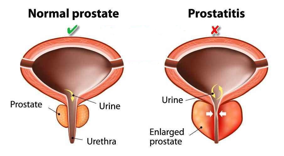 پروستاتیت یا التهاب پروستات چیست