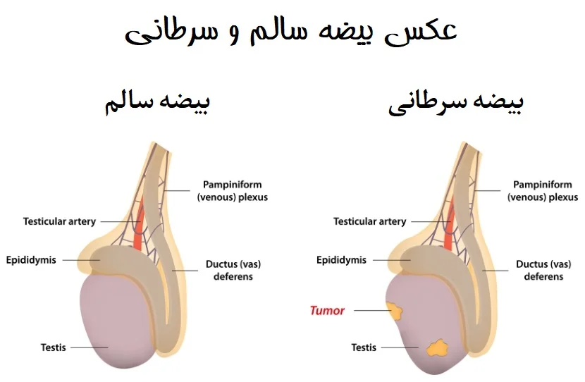 علائم سرطان بیضه پیشرفته