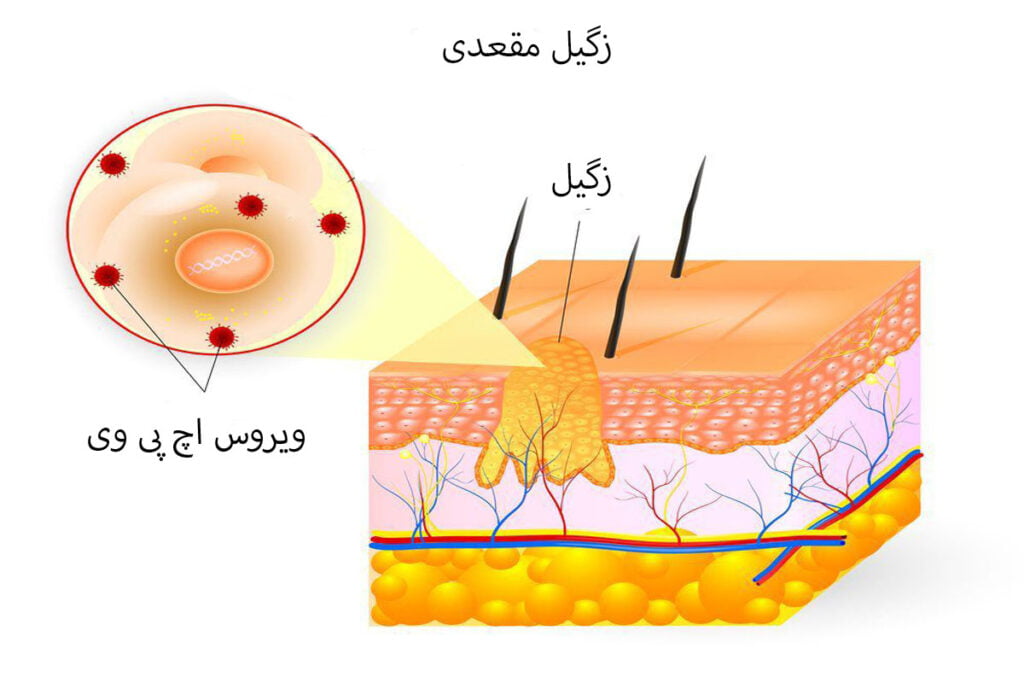 درمان زگیل مقعدی در خانه