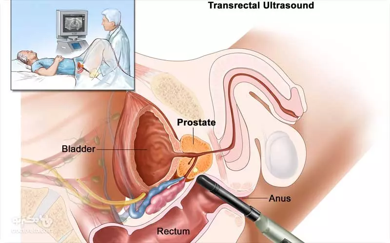 پروستاتیت حاد چیست