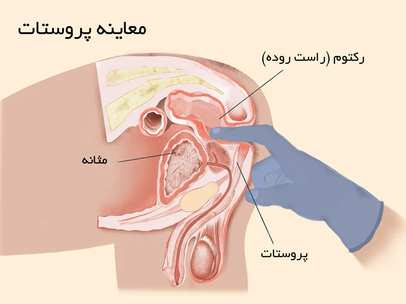 چه کسی بیشتر در معرض ابتلا به پروستاتیت است؟