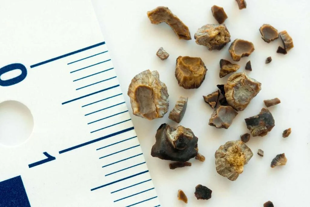 مشکلات مربوط به سنگ کلیه