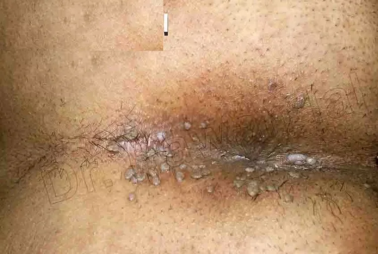 زگیل مقعدی خفیف